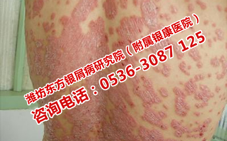 濰坊看牛皮癬理想的醫院