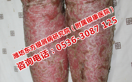 專門治牛皮癬的醫院