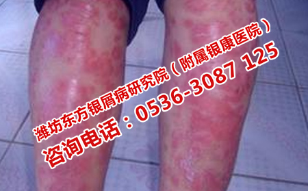 看銀屑病治療效果理想的醫(yī)院