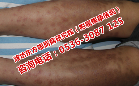 濰坊治銀屑病的費用