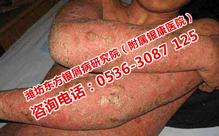 關節型銀屑病會癱瘓嗎