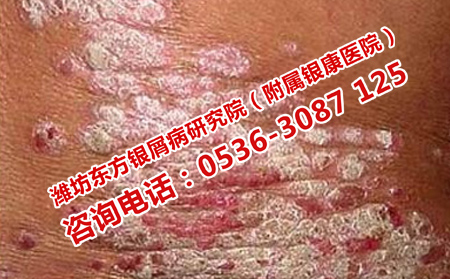 壽光治療銀屑病