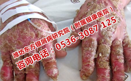 濰坊治銀屑病理想的醫院