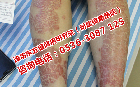 濰坊治銀屑病的費用