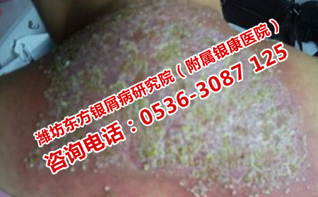 冬季護理膿皰性銀屑病