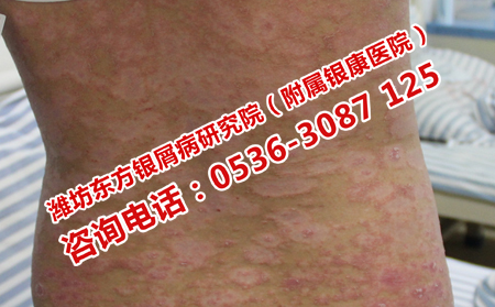 治療銀屑病理想的療法