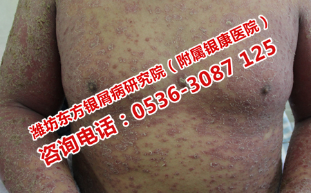 濰坊看銀屑病的專(zhuān)門(mén)醫(yī)院