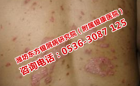 冬季預(yù)防銀屑病反復(fù)