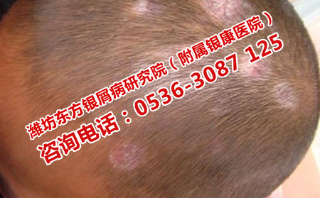 濰坊比較理想的銀屑病醫院