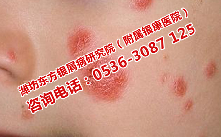 安丘理想點的銀屑病醫院