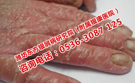 治理想女性牛皮癬