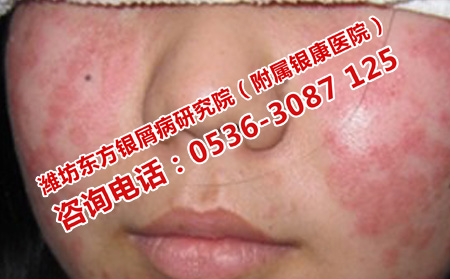 兒童銀屑病醫院濰坊