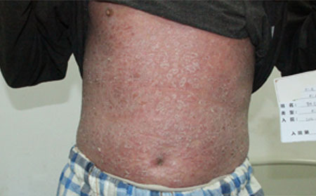 銀屑病如何護(hù)理越理想