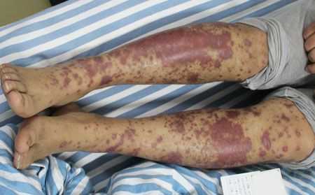 安丘中醫(yī)治銀屑病