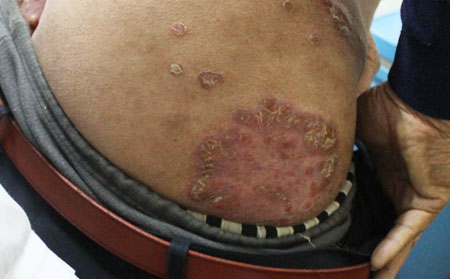 男性銀屑病恢復時間