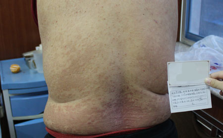 去哪里能擺脫銀屑病