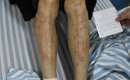 治療銀屑病理想的專科醫院