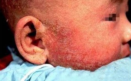 銀屑病復發的四大誘因