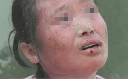 濰坊牛皮癬醫院治療效果理想嗎