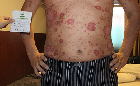 全身尋常性銀屑病能治理想嗎