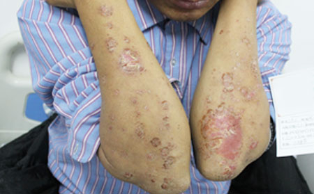 青州治銀屑病的價格