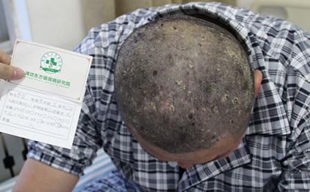 老人銀屑病的特點有哪些