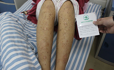 如何預防兒童銀屑病的復發