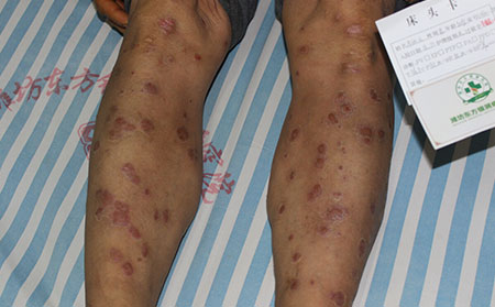 規范治療實現銀屑病的恢復