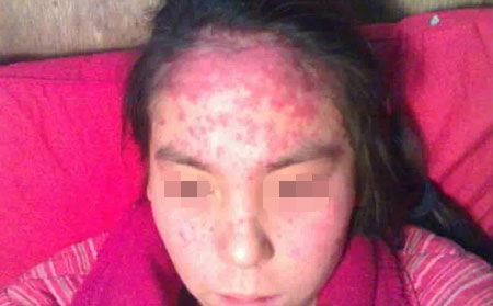 銀屑病忌口的食物