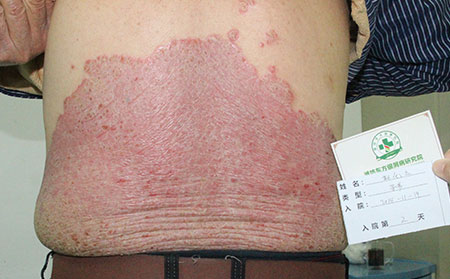 寒亭哪里治銀屑病理想