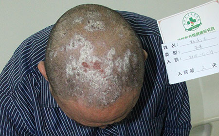 老人銀屑病不理想的原因