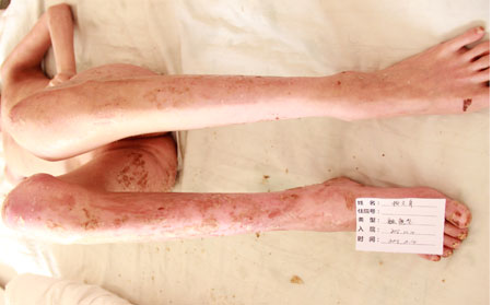 尋常性銀屑病的癥狀