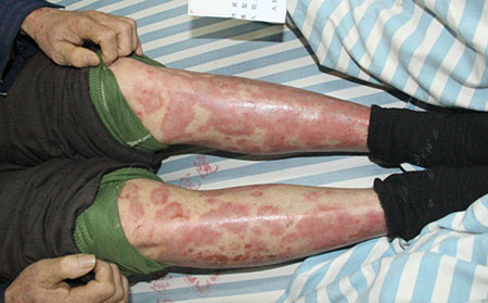 區分銀屑病關節炎和類風濕關節炎