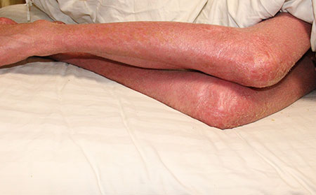 治療女性銀屑病理想的醫院