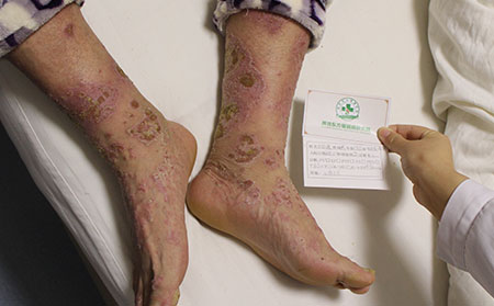 銀屑病的癥狀如何診斷