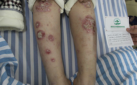 關節型銀屑病治療時間