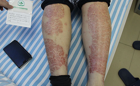 溫暖春季如何預防銀屑病