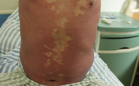 中醫(yī)治銀屑病理想的醫(yī)生