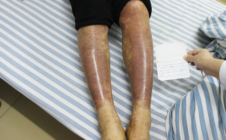 哪家醫院治療銀屑病理想