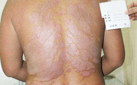 兒童銀屑病恢復的關鍵