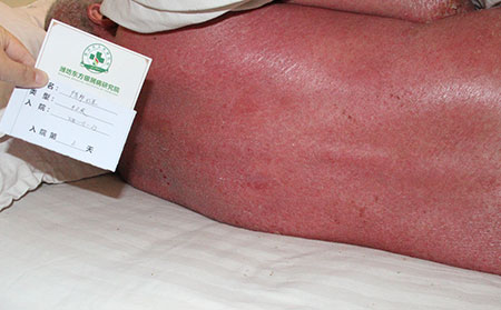 紅皮型牛皮癬的原因