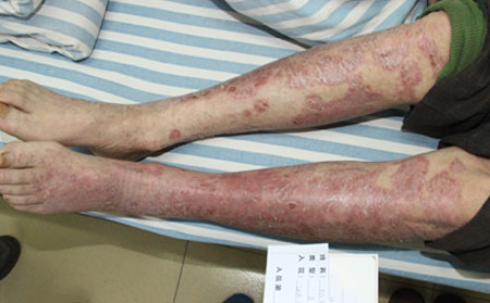 銀屑病治療正規醫院