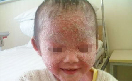 頭部牛皮癬的按摩護理