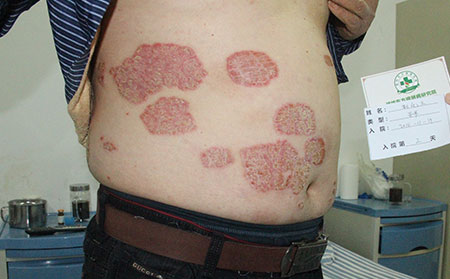 不同時期的銀屑病癥狀