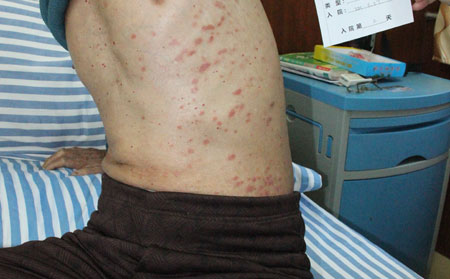 老年銀屑病久治不愈