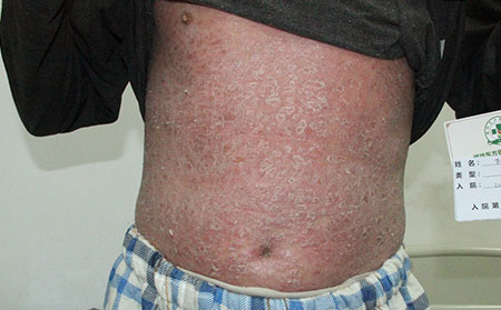 預防銀屑病反復的辦法