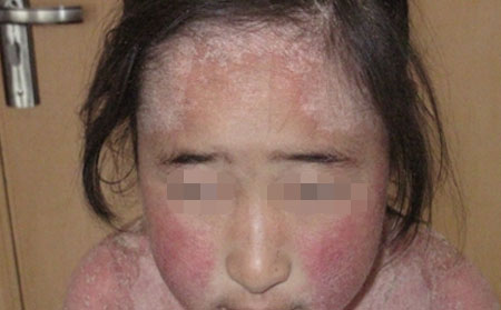 銀屑病治療的騙局