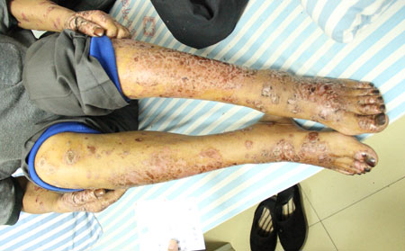 如何預(yù)防牛皮癬復(fù)發(fā)