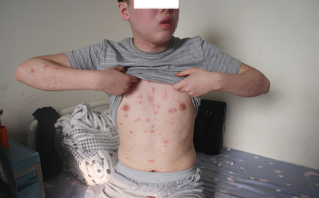 男性突發牛皮癬的原因是什么