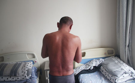 男性牛皮癬治療效果理想的方法是什么